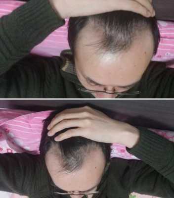 头发脱的很厉害怎么办（头发脱的很厉害怎么办啊）