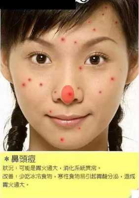 为什么鼻子上长痘痘怎么办（鼻子上的痘痘怎么去掉）
