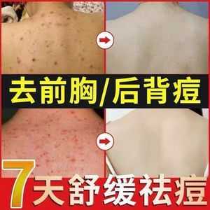 背后痘痘怎么去除（背后痘痘怎么去除痘印）