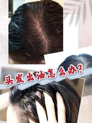 头发油性怎么办（头发爱出油该怎么办）