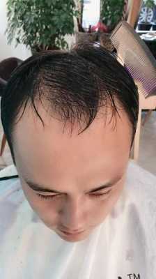 什么是秃鬓角,秃鬓角怎么回事怎么才能长鬓角