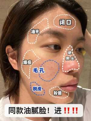 脸上长青春痘怎么去除（脸上长青春痘怎么去除小妙招）