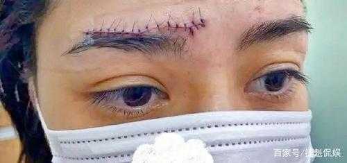 遮额头是什么意思,怎么遮住额头上的疤痕