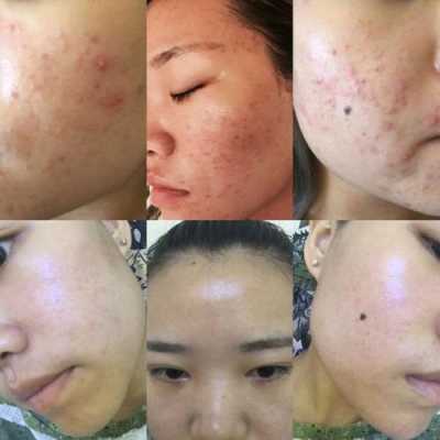 脸上长痘痘要吃什么（脸上长痘痘要吃什么药效果最好）