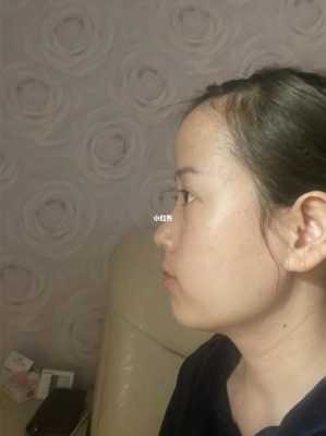 脑门凸怎么办（脑门有点凸）