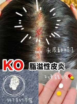 头皮坏了怎么办（头皮坏了怎么办?）