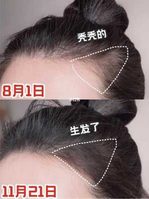 鬓角头发太少怎么解决,鬓角头发少怎么办女生