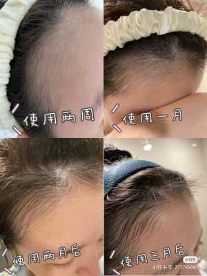 额头汗毛多如何去除,额头毛发多怎么办女生