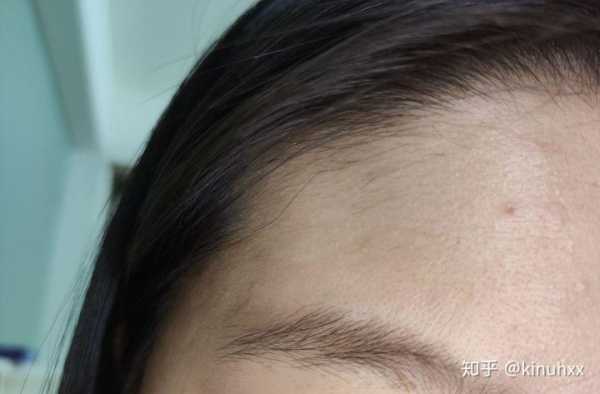 额头汗毛多如何去除,额头毛发多怎么办女生