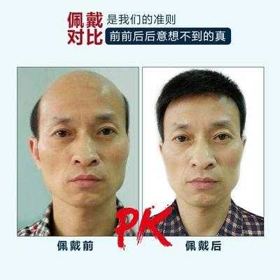 老年人是选假发块好还是选毛寸好,怎么选择假发的好坏