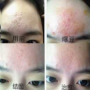 脸上的白头粉刺怎么去除（怎样去除脸上的白头粉刺）