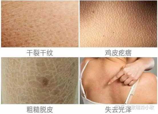 皮肤干掉皮怎么办（皮肤干掉皮怎么办?）