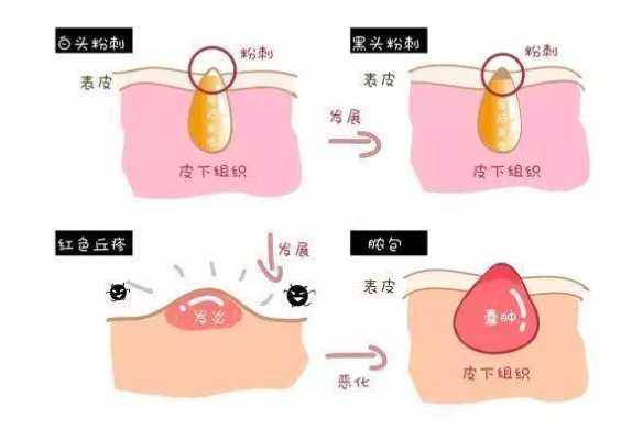 开口粉刺和闭口怎么区分（闭口和痘痘的区别）
