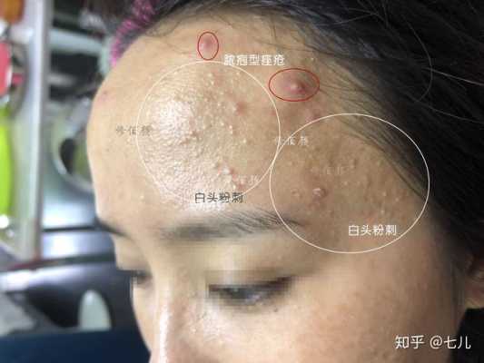开口粉刺和闭口怎么区分（闭口和痘痘的区别）