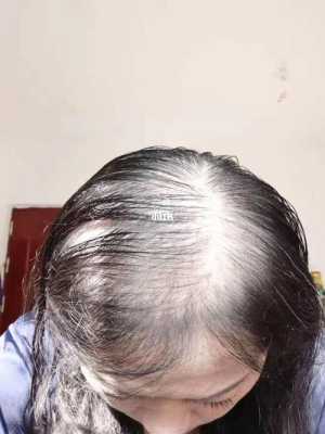 女性溢脂性脱发怎么办（女性溢脂性脱发怎么办吃什么药）