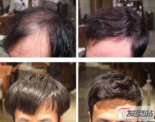 男的头顶头发少怎么办（男的头顶头发少怎么办）