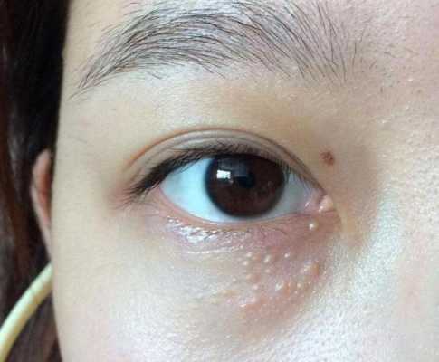 脸上很多脂肪粒怎么办（脸上长脂肪粒去除小妙招）