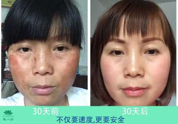 如何祛除脸上的雀斑,雀斑用什么洗
