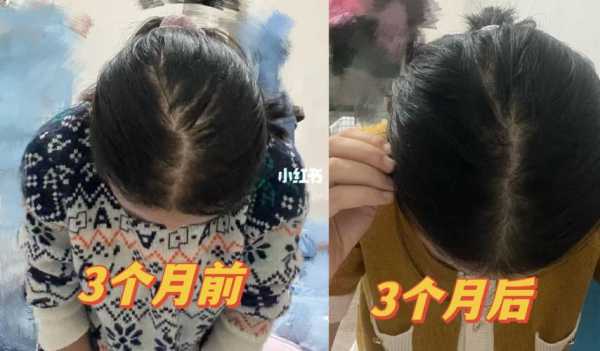宝宝三岁了，现在头顶头发稀少，应该怎么办呢？还能长出头发吗,头发少怎么长多点