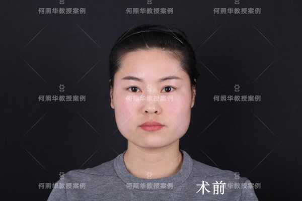 大方脸怎么改善脸型,方脸怎么整容