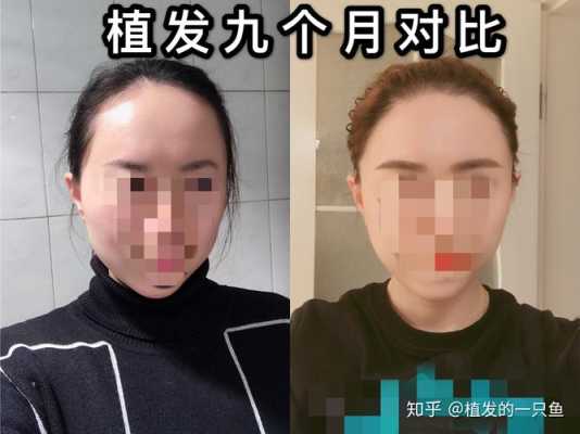 前额秃怎么办（前额秃怎么办女生）