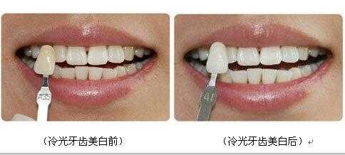 怎么自己美白（怎么自己美白牙齿）