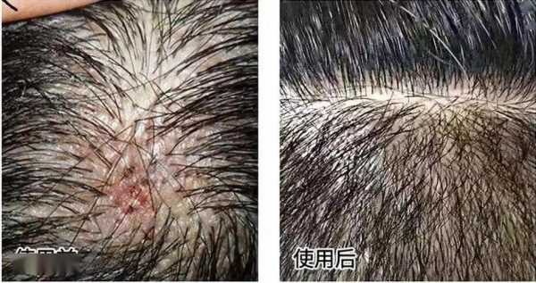 为什么长时间不洗头会有皮块,头发为什么有头屑的原因