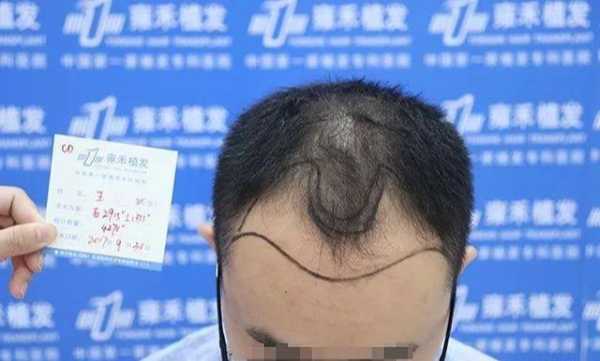 头顶发稀怎么治疗（头顶发稀怎么治疗好）