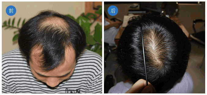 手术后脱发怎么办（手术后脱发怎么办）