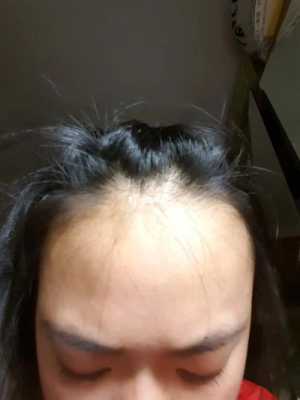 脑门长头发是怎么回事（脑门长头发是怎么回事儿）