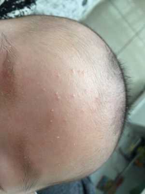 小孩脑袋上长了好多小痘痘，这是怎么回事呢,头脑上长痘是什么原因引起的