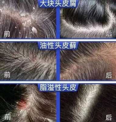 头发头皮屑多的原因,头皮屑好多是什么原因?