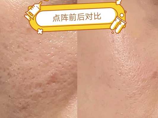毛孔怎么才能缩小（毛孔怎么才能缩小呢）