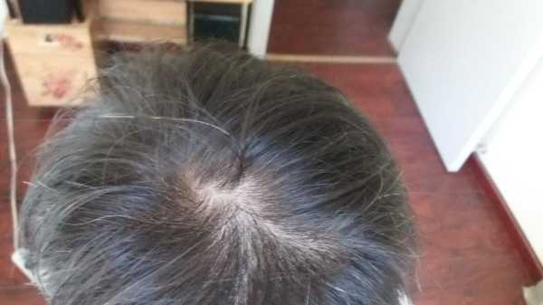 脱发该怎么办,脱发怎么办才好