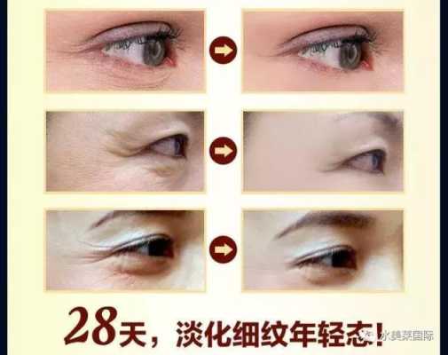 眼纹怎么治（眼纹怎么治疗）