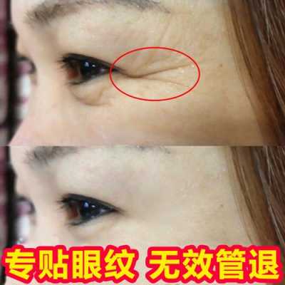 眼纹怎么治（眼纹怎么治疗）
