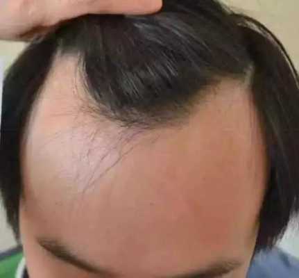 脑门秃怎么办（脑门秃发际线高怎么办）