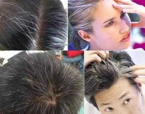 少年为什么会有白发（青少年白头发正常吗）