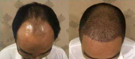 掉发很严重怎么办?如何治疗脱发,脱发怎么办呀.都成秃头了
