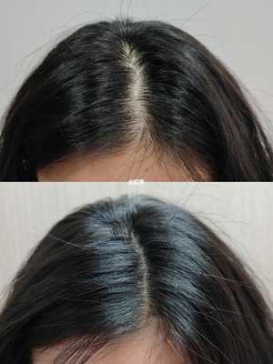 掉发很严重怎么办?如何治疗脱发,脱发怎么办呀.都成秃头了