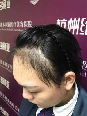 我两个额角的地方掉头发，有两三年了植发要多少钱,额角脱发适合什么发型女
