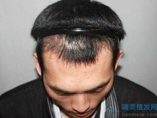 我两个额角的地方掉头发，有两三年了植发要多少钱,额角脱发适合什么发型女
