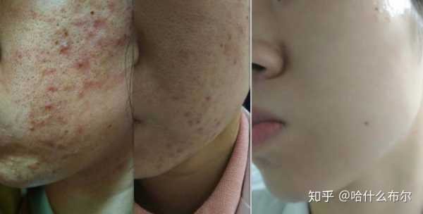 怎么治疗痘痘,怎么样能够祛痘痘最有效