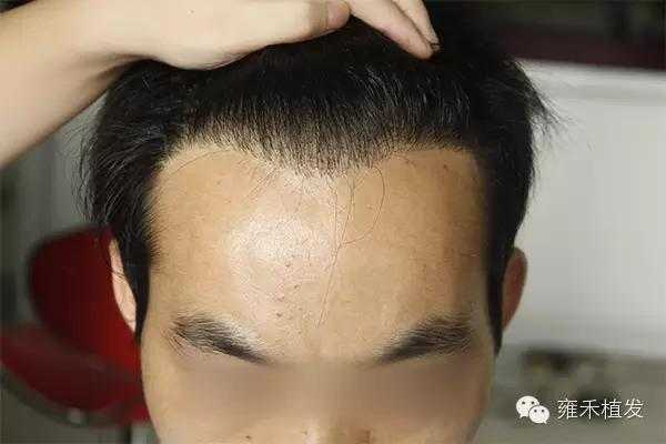 什么是发际线高,什么叫发际线高大全