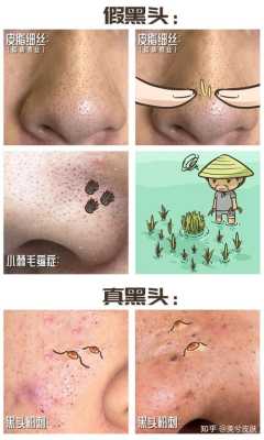 怎么样去鼻子黑头（怎么样去鼻子黑头最有效最快）