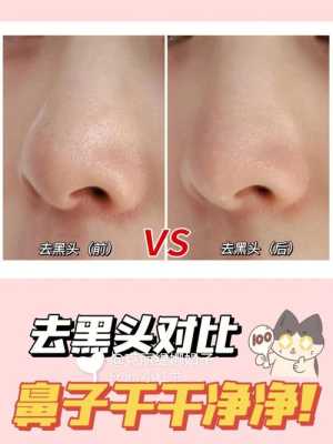 怎么样去鼻子黑头（怎么样去鼻子黑头最有效最快）