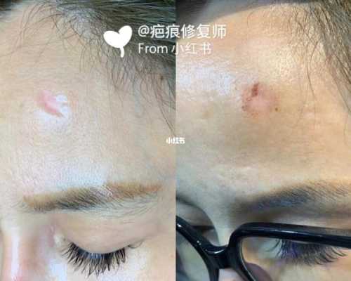 额头的头发怎么弄好看（我额头上有个疤，要怎么做头发才好看呢）