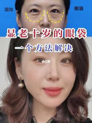 眼袋怎么消除简单方法一（红霉素眼膏去眼袋的最快方法）