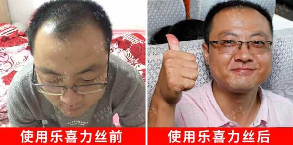 中年人脱发怎么办（55岁以后头发还能生长出来）