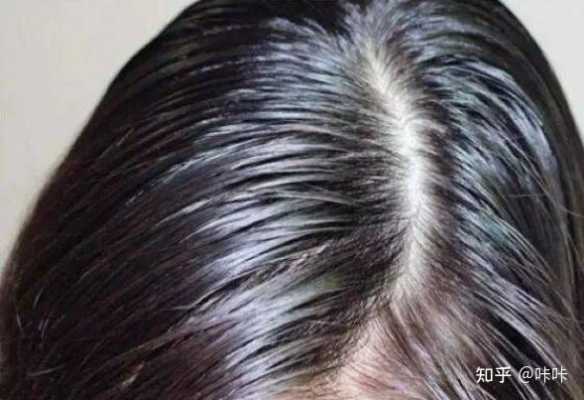 掉头发是什么原因如何治疗,油性头发掉发怎么办女性
